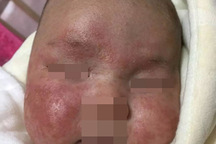 婴儿期特应性皮炎面部丘疹图 婴儿期特应性皮炎面部丘疹图