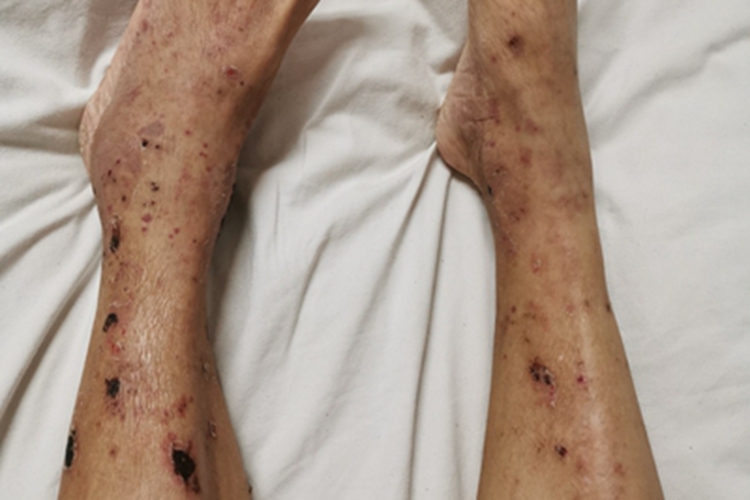 皮肤型结节性多动脉炎小腿血痂图