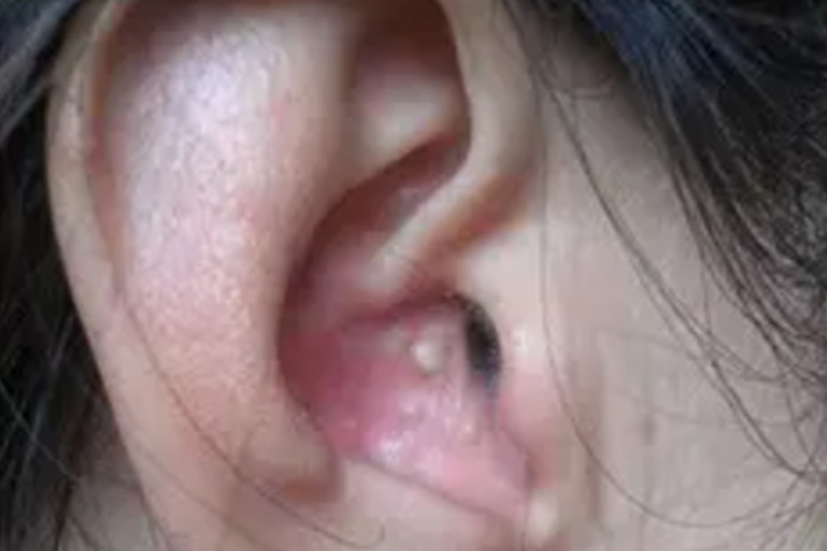 外耳道白头粉刺图