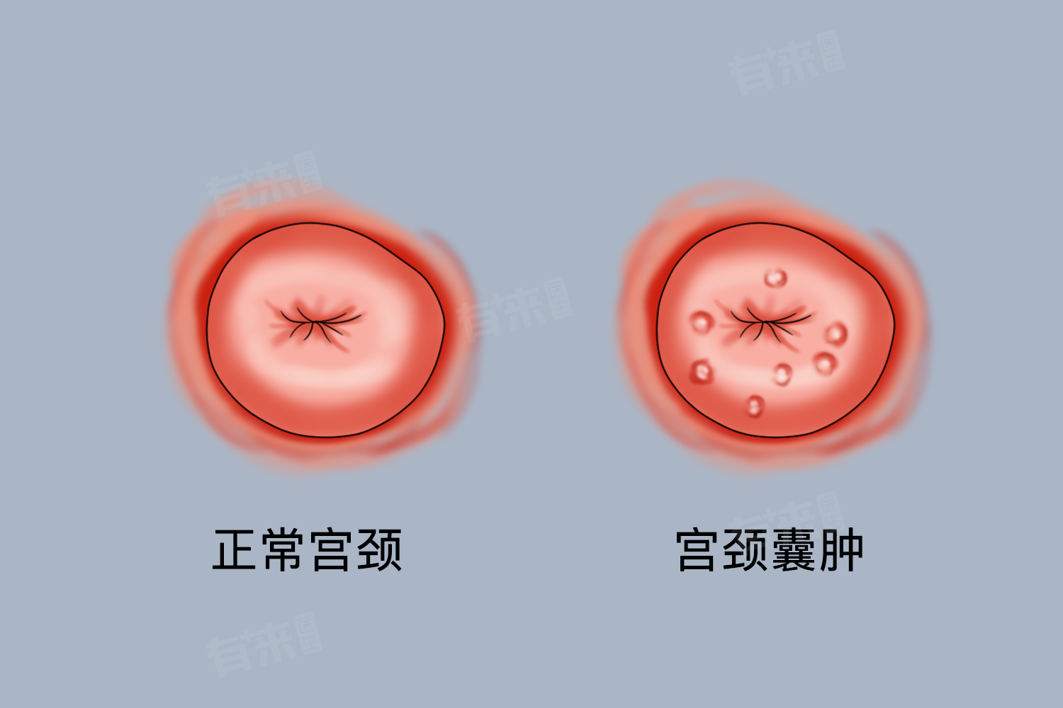 子宫颈纳博特囊肿：迹象、病因及3种危险并发症