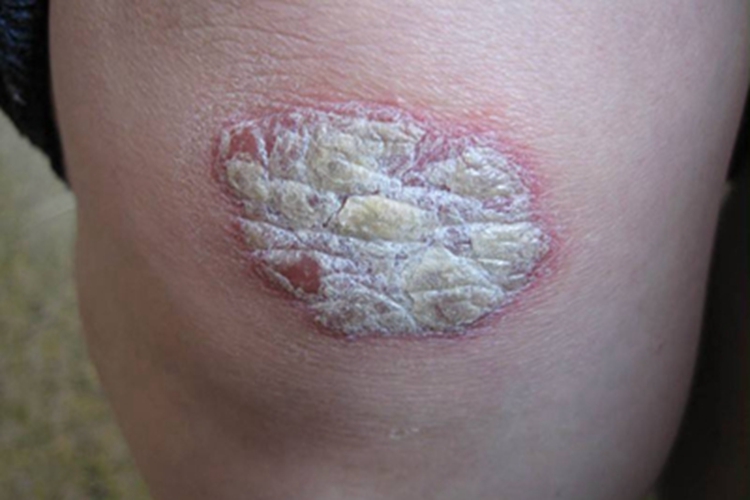 银屑病关节炎膝盖白斑图 银屑病关节炎膝盖白斑图