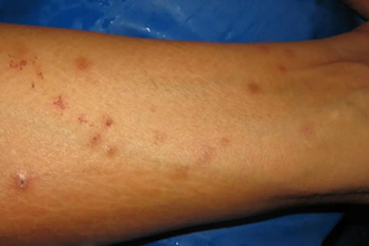 血吸虫尾蚴皮炎血痂图