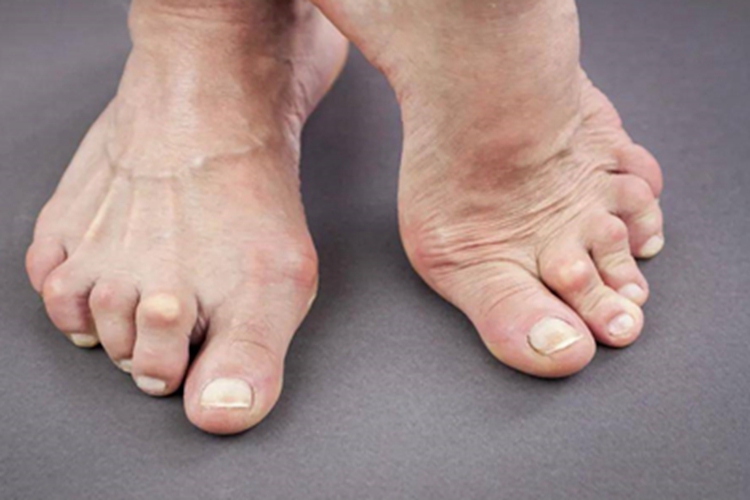 类风湿关节炎脚趾症状图