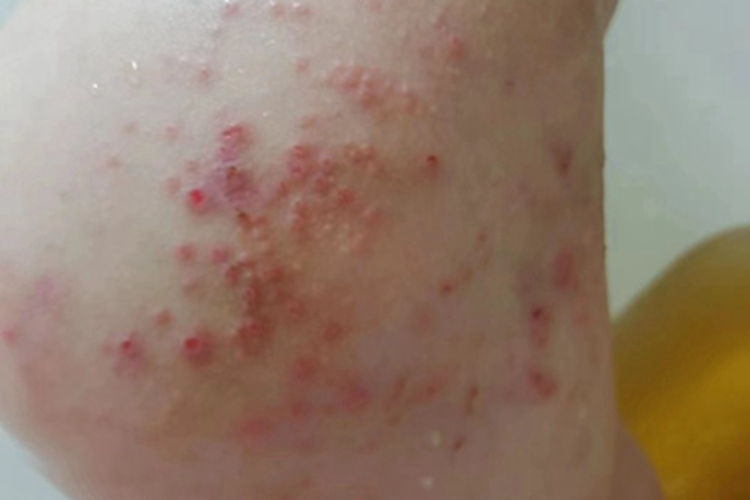 青年成人期特应性皮炎胳膊疹子图