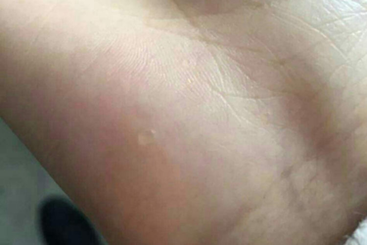 掌跖点状角化水疱图