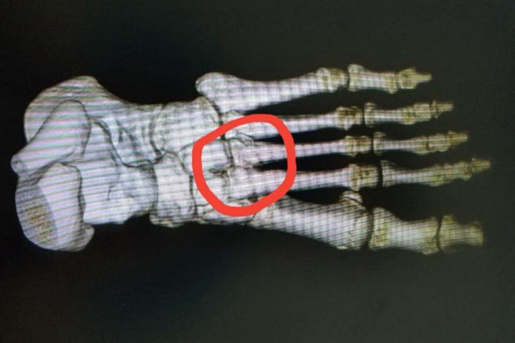 左脚第二三跖骨骨折图 左脚第二三跖骨骨折图