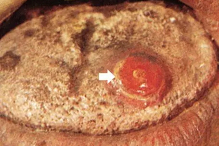 一期口腔梅毒舌头上有溃疡图