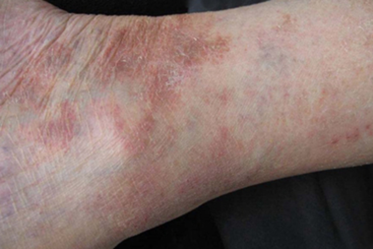青年成人期特应性皮炎脚踝斑图 青年成人期特应性皮炎脚踝斑图