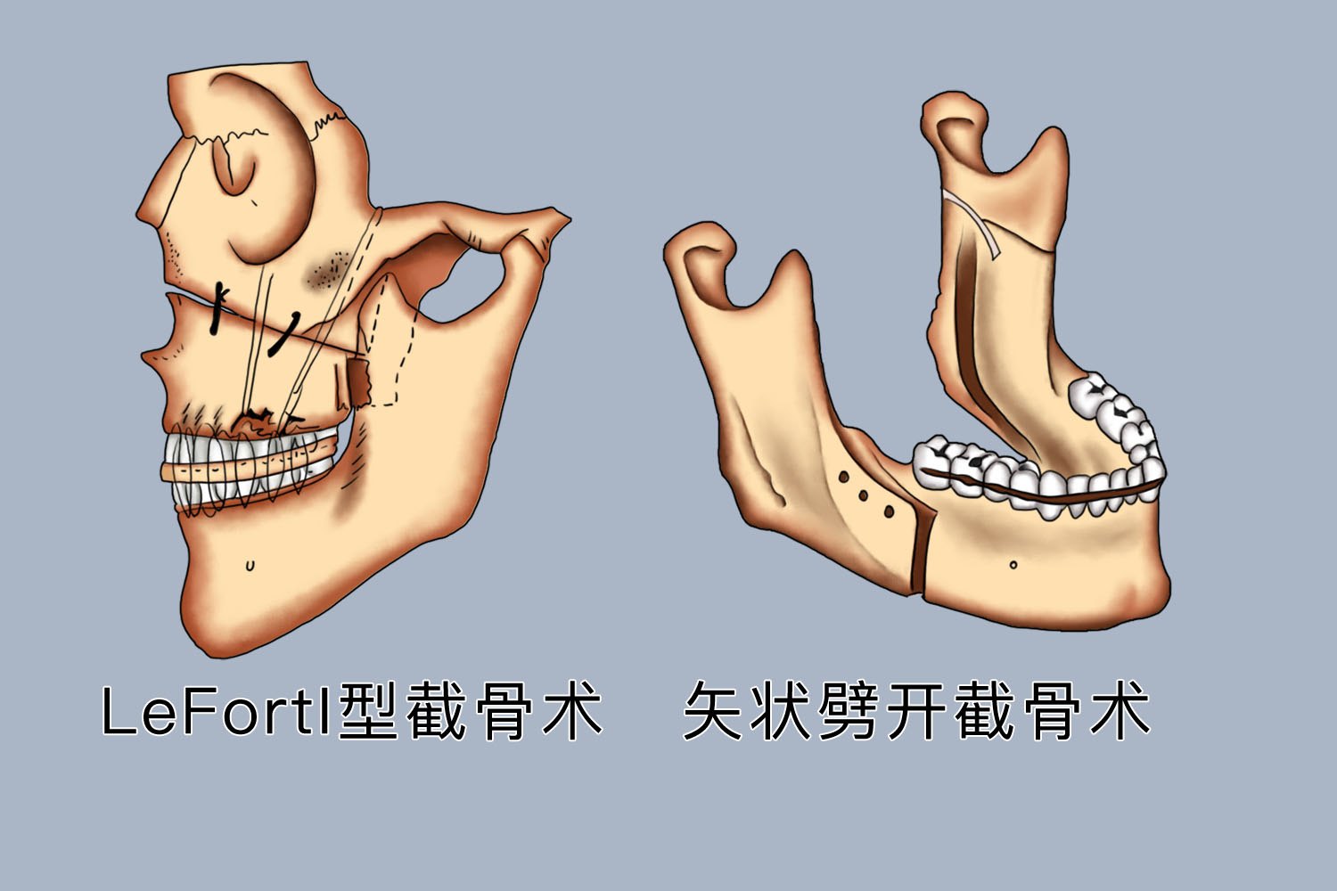 手术矫治图 手术矫治图