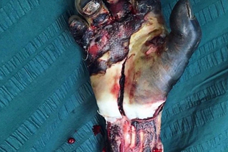 电烧伤手部缺损图