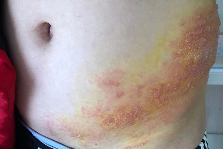 初始群集丘疱疹图 初始群集丘疱疹图