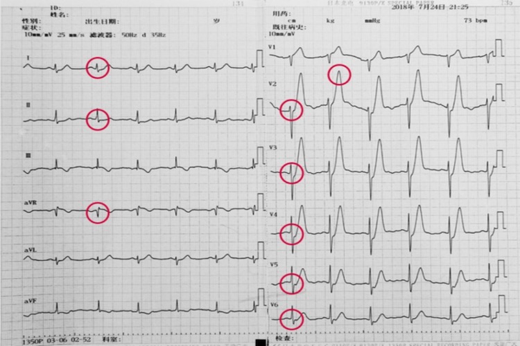 心电图T波高尖图 心电图T波高尖图