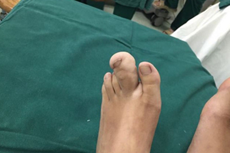 巨指畸形第二脚趾肥大图 巨指畸形第二脚趾肥大图