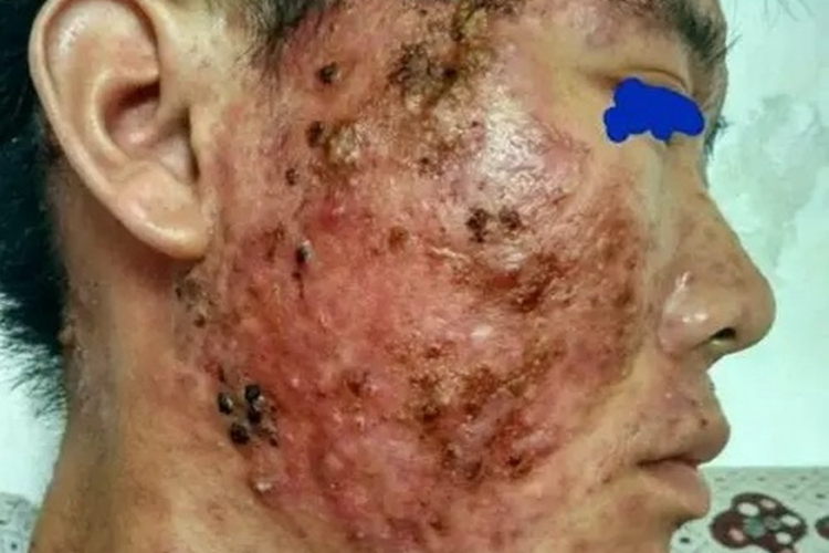 骨嗜酸性粒细胞肉芽肿面部症状图 骨嗜酸性粒细胞肉芽肿面部症状图