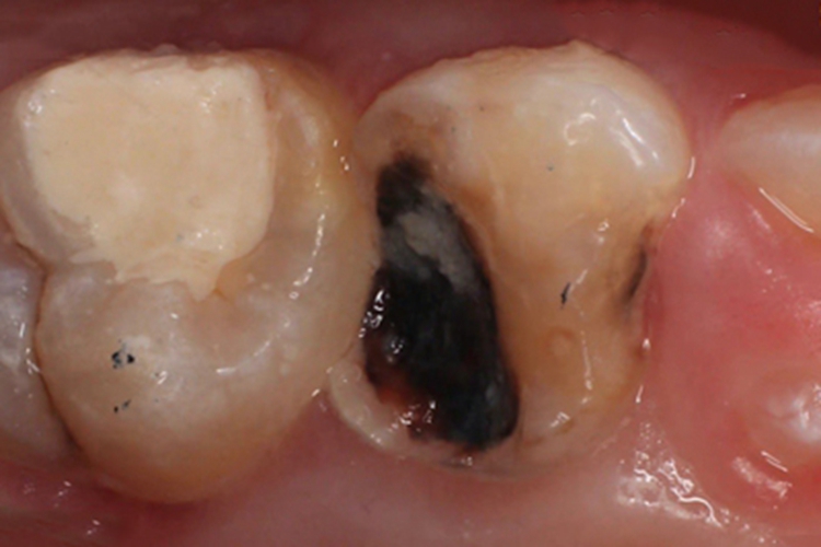 年轻恒牙龋黑斑图