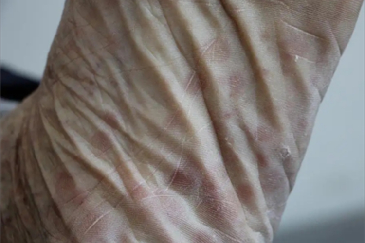 三期梅毒脚底症状图 三期梅毒脚底症状图