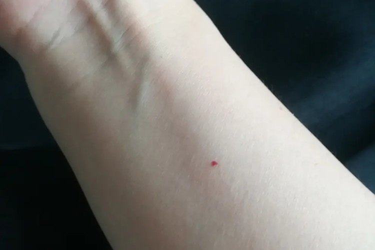 胳膊樱桃样血管瘤图