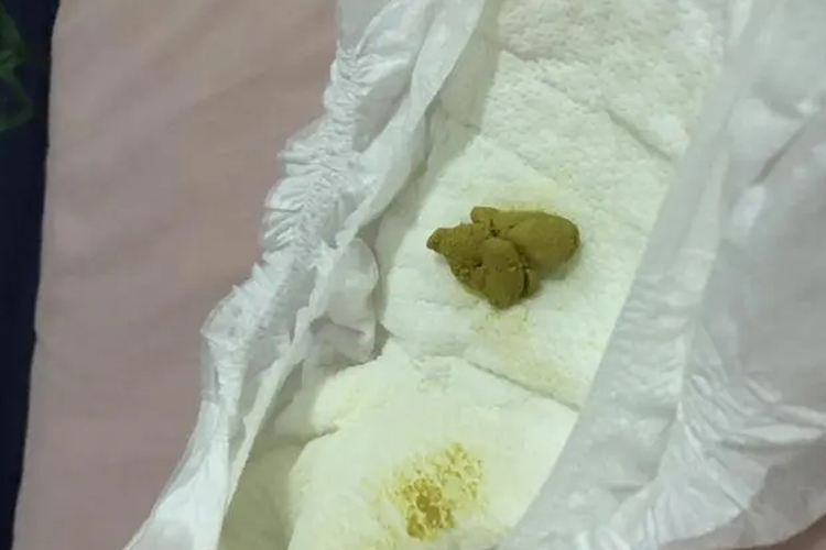 新生儿大便干燥图