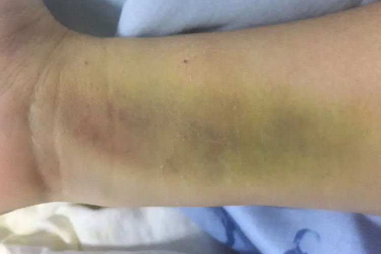 凝血功能障碍手腕拍出瘀血图