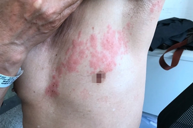 带状疱疹胸部症状图