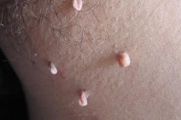 大腿根皮赘图 大腿根皮赘图