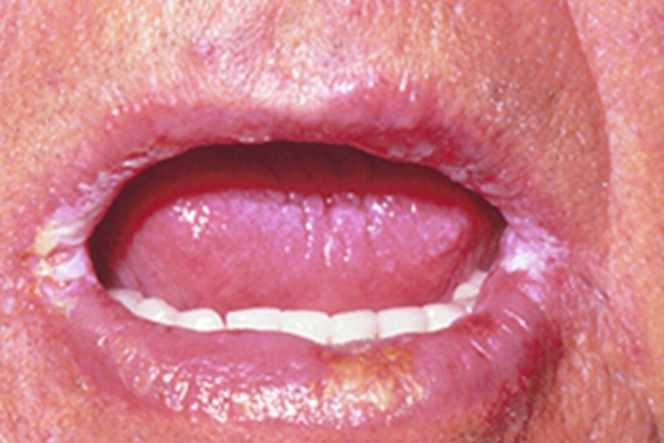 营养不良性口角炎嘴唇症状图