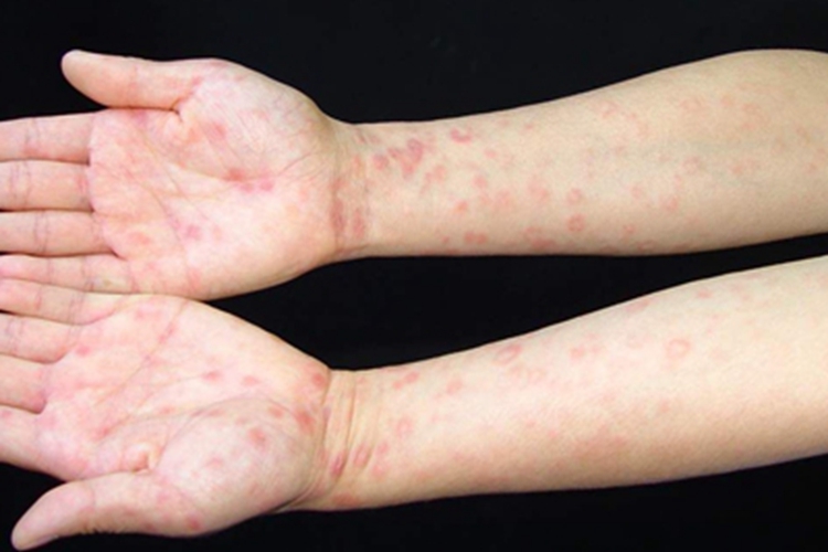 斑疹性梅毒疹胳膊症状图