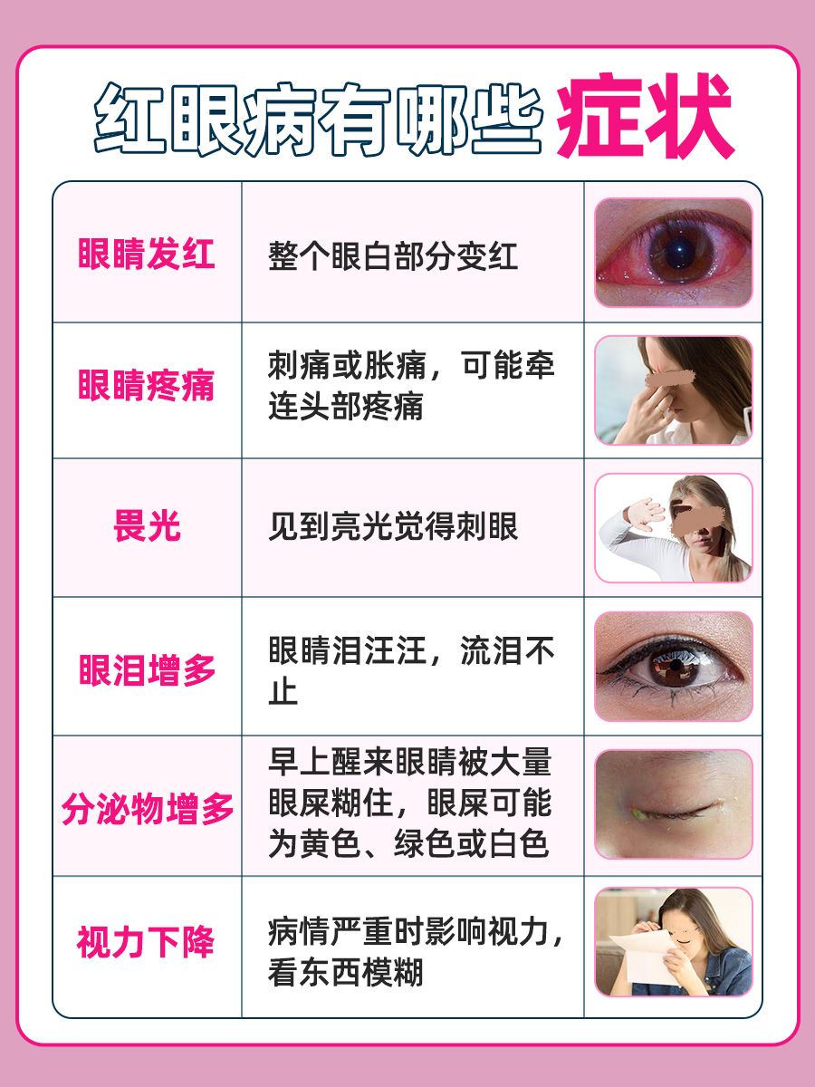 红眼病有什么症状，快来看看你中招了没！