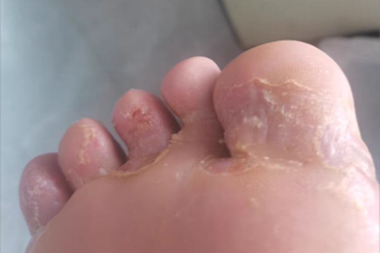 浸渍糜烂型足癣脚趾糜烂图