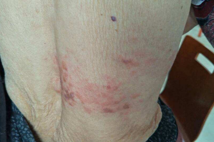 蜘蛛疮快好时图