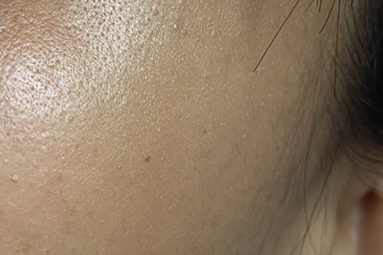 交界痣脸上棕色斑点图 交界痣脸上棕色斑点图