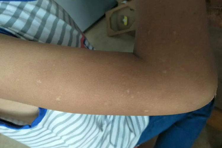 贫血痣手臂上有白色的小圆点图 贫血痣手臂上有白色的小圆点图