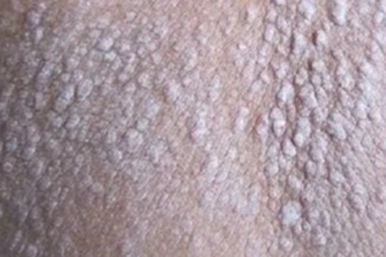 苔藓样型副银屑病症状图 苔藓样型副银屑病症状图