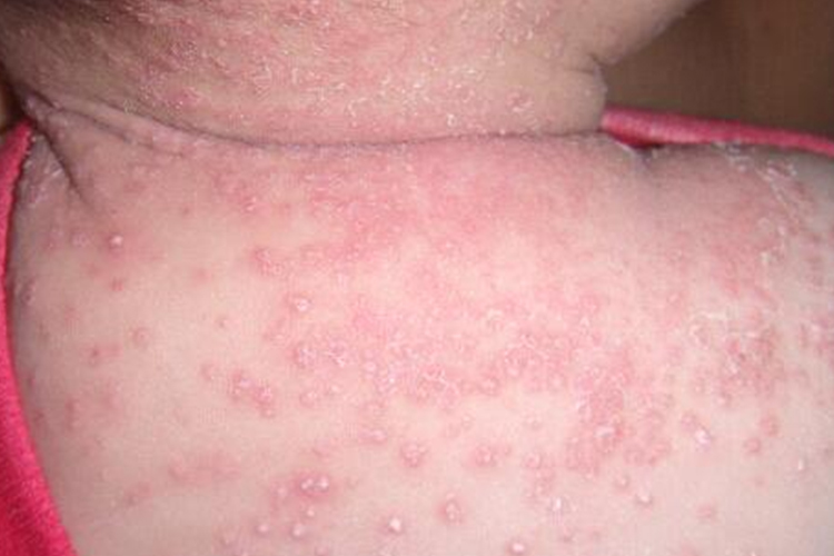 婴儿脂溢性皮炎鳞屑图