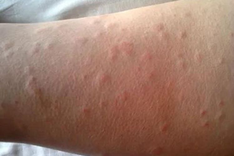 冷接触性荨麻疹红点图 冷接触性荨麻疹红点图