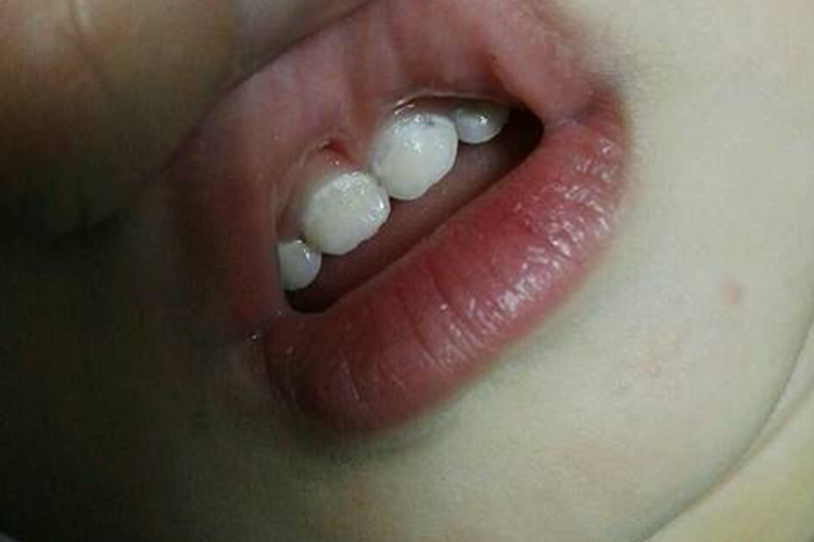 门牙钙化图 门牙钙化图