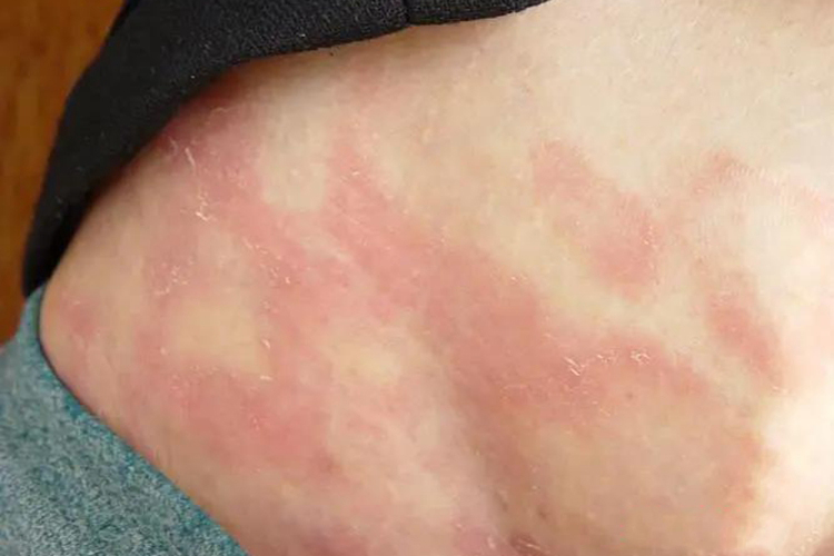 早期MF皮肤病图