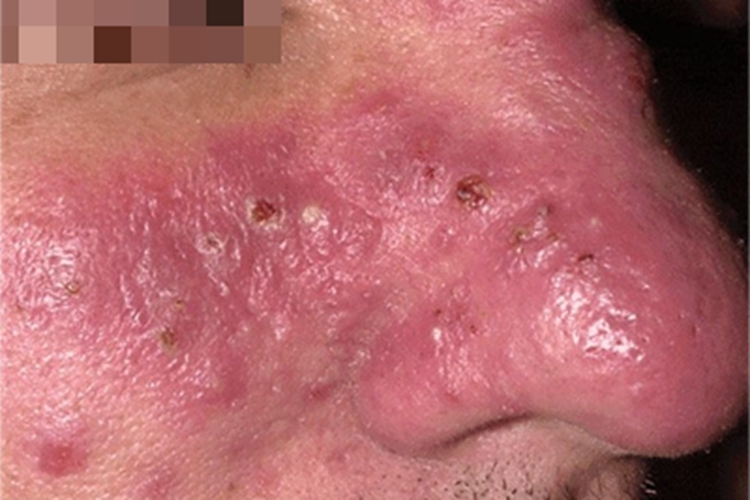 丘疹脓疱型玫瑰痤疮脓包图