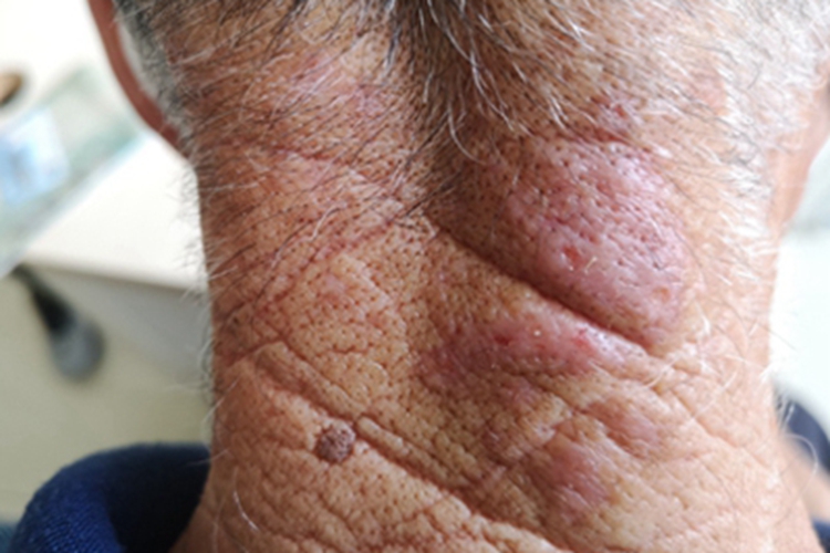 项部菱形皮肤后颈凹凸不平图 项部菱形皮肤后颈凹凸不平图