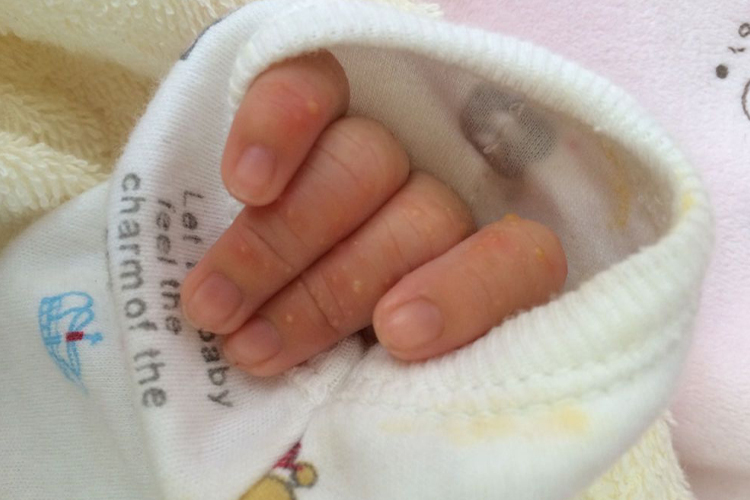 湿疹手指皮下长疹图