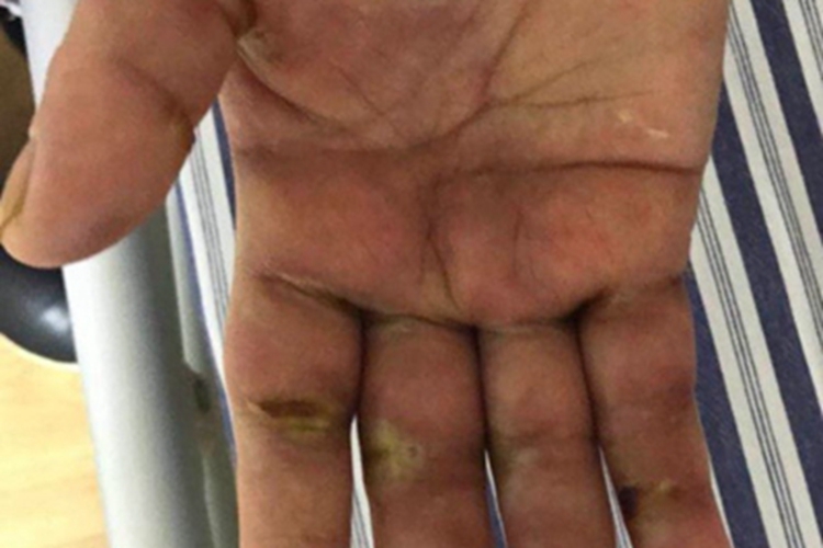 4级手足综合征水疱图