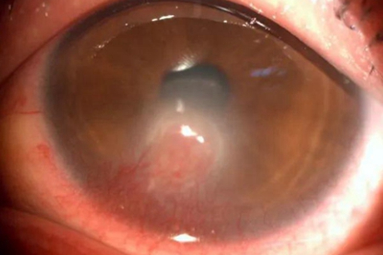 瘢痕性睑内翻角膜症状图 瘢痕性睑内翻角膜症状图