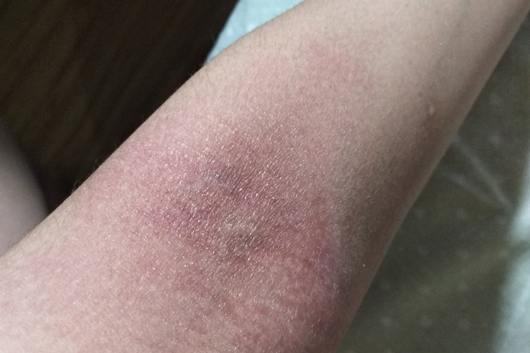 吃海螺过敏湿疹图 吃海螺过敏湿疹图