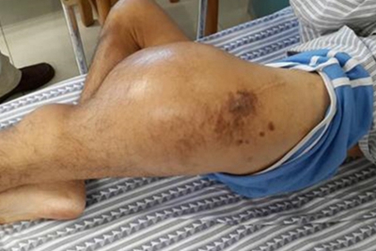 恶性纤维组织细胞瘤膝盖肿块图