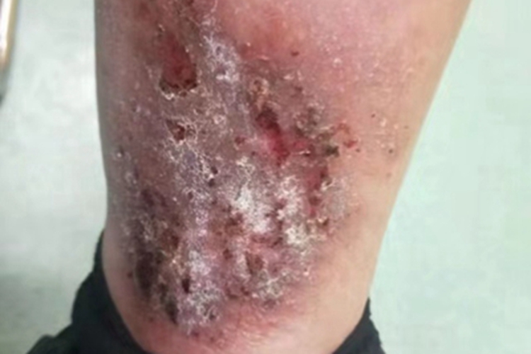亚急性湿疹小腿有血痂图