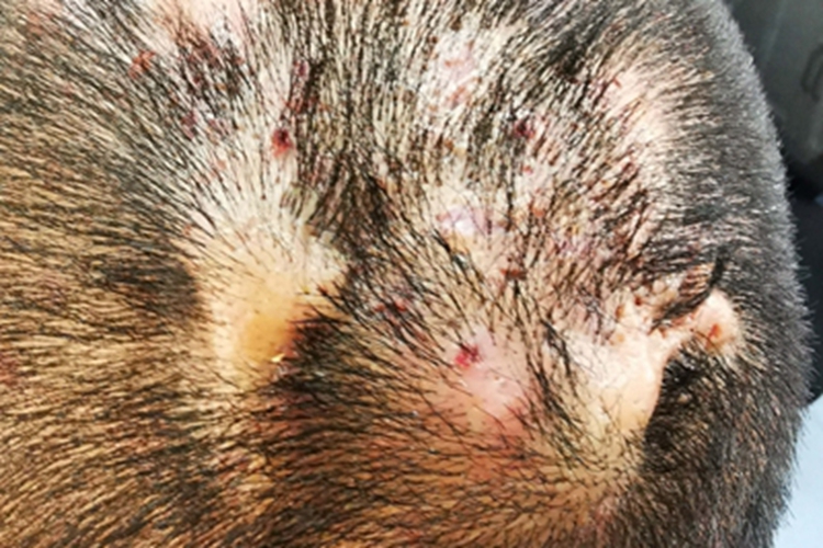 毛囊炎头皮长红疙瘩还脱发图 毛囊炎头皮长红疙瘩还脱发图