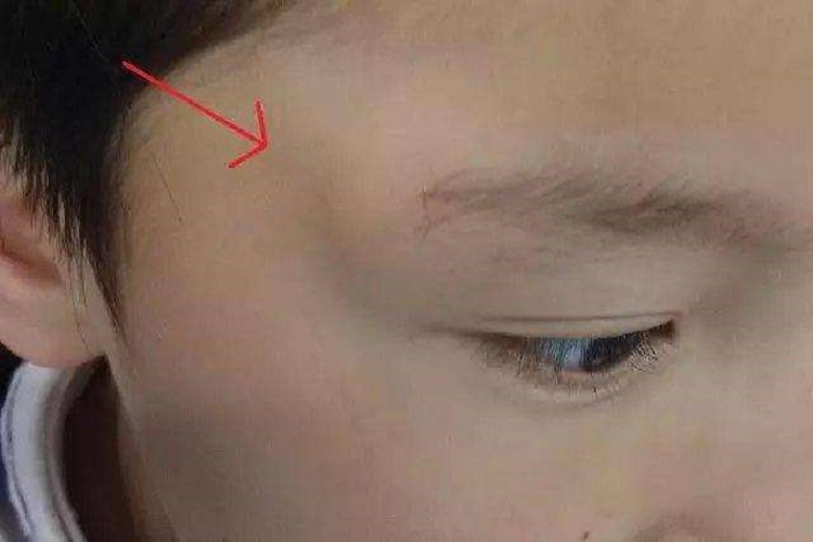 宝宝眉弓囊肿图