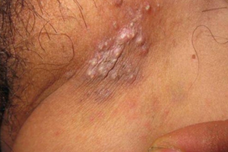 福克斯-福代斯病大腿小疙瘩图 福克斯-福代斯病大腿小疙瘩图