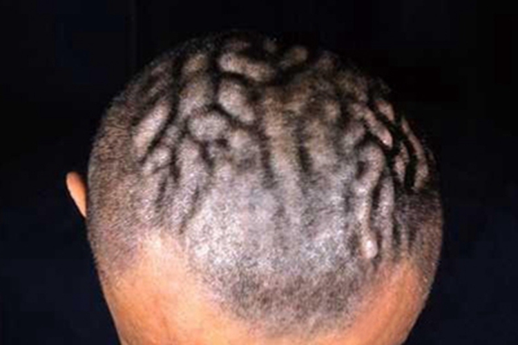 原发性骨膜增生厚皮症头皮不平图