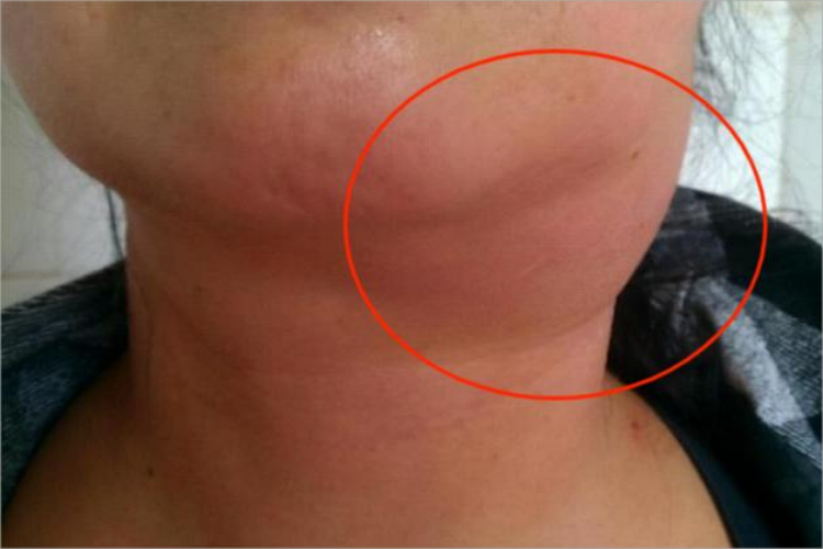 颌下腺炎症状图